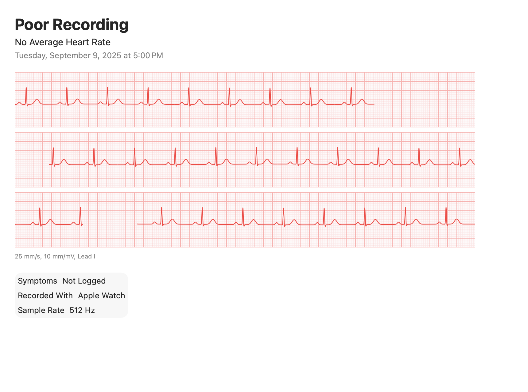 Electrocardiograms: Poor recording, with gaps