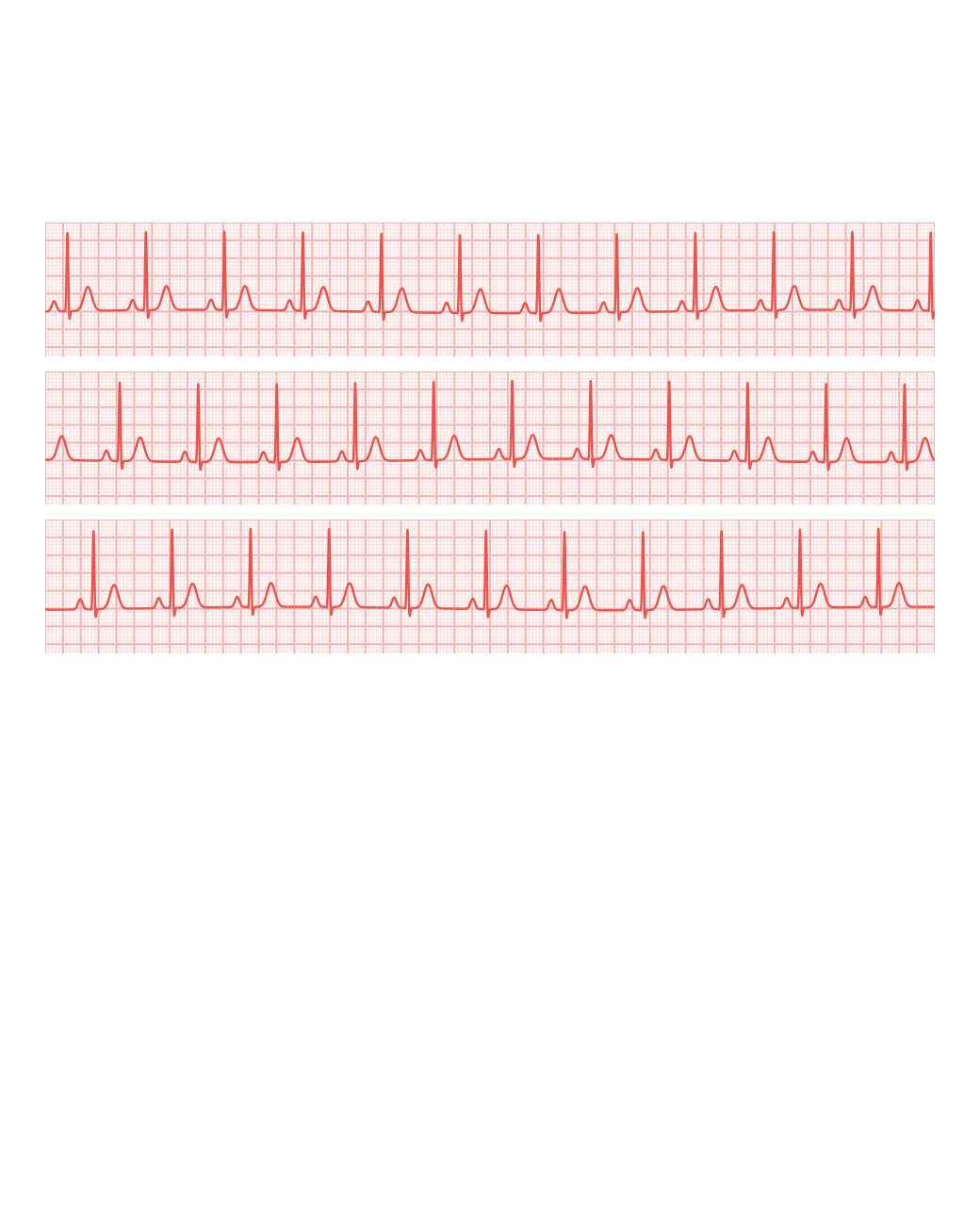 Electrocardiograms: Tall waves, narrow window