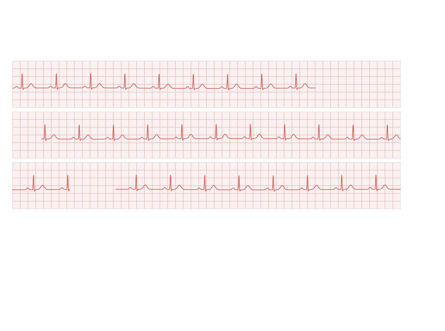 Electrocardiograms: Poor recording, with gaps
